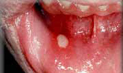 درمان آفت دهان با کشف فرمولاسیون جدید گیاهی